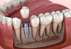 dental implant integrating with the jawbone 