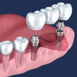 dental implant supported fixed bridge