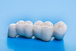 Example of a traditional dental bridge in Downers Grove
