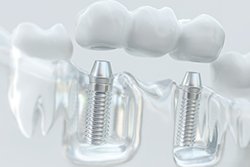 Example of an implant dental bridge in Downers Grove