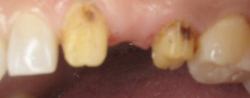 Closeup of missing tooth