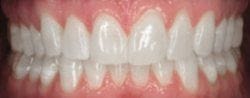 Closeup of bright smile after teeth whitening