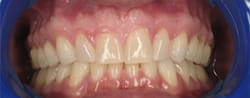 Clsoeup of perfectly aligned smile aftre Invisalign treatment