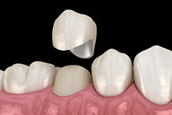 A 3D illustration of a dental crown being placed