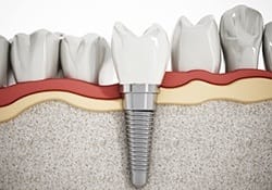 Animation of implant supported dental crown