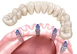 Implant dentures in Downers Grove