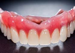 Upper denture in Downers Grove