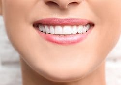 Close up of smile after direct bonding