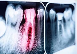 Dental X-ray captured by an emergency dentist in Downer’s Grove