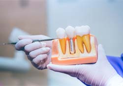 Dentist pointing to parts of dental implant in Downers Grove