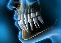 X-ray of a patient with a dental implant in Downers Grove