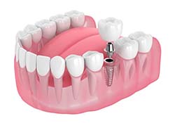 single dental implant with a crown