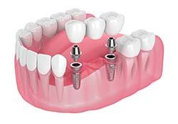 two dental implants with a dental bridge