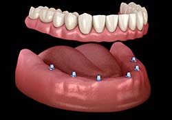 six dental implants with a full denture