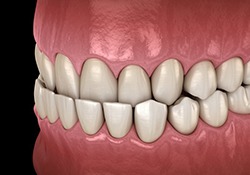 a 3D depiction of an underbite