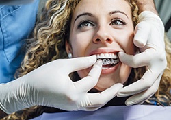 Woman smiles while being fitted for Invisalign