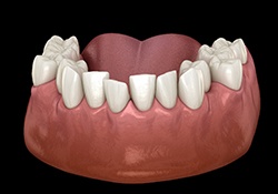 Diagram showing overcrowded teeth