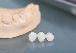 Fixed bridge dental restoration