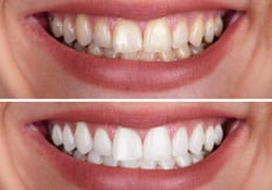 before and after teeth whitening