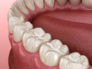 A digital image of a tooth-colored filling