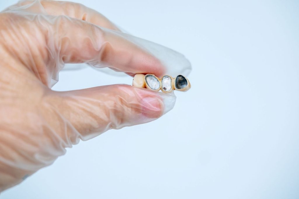 A dental restoration with a metal base